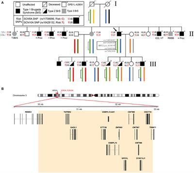 The role of GPD1L, a sodium channel interacting gene, in the pathogenesis of Brugada Syndrome